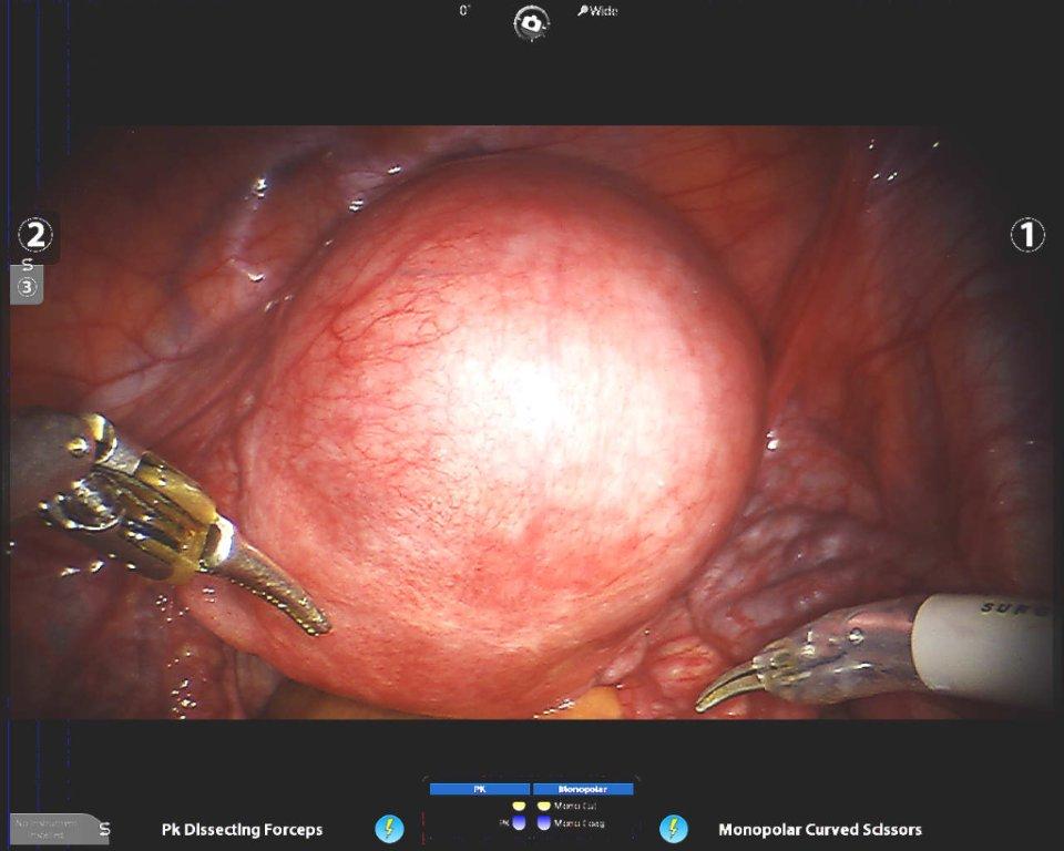 Laparoscopy1