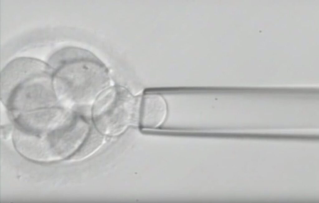 PGD Biopsy