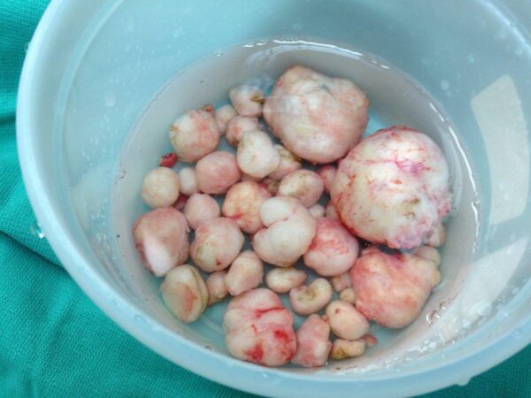 Fibroids