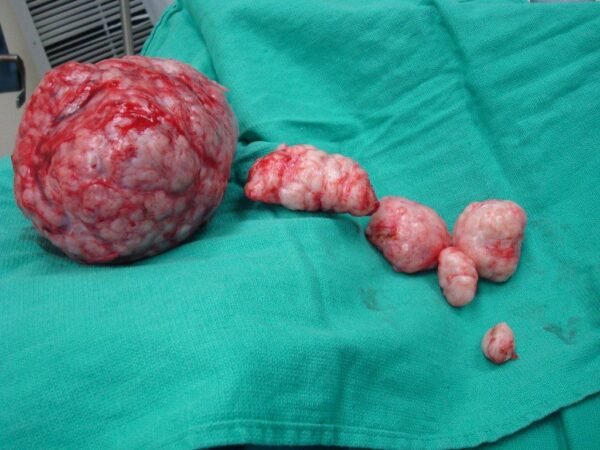 Fibroids2