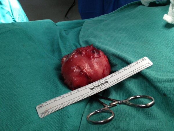 Uterus after Myomectomy