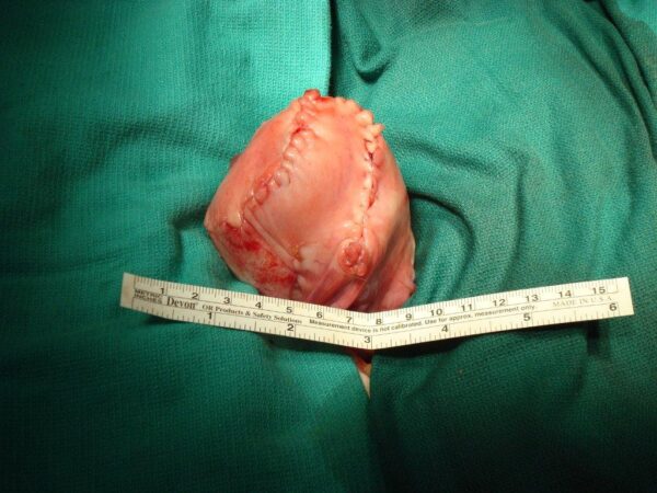 Uterus after repair